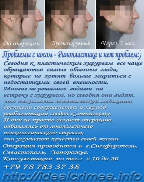 Ринопластика - изменение формы и размера носа. Крым