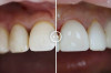 Эстетическое и функциональное восстановление зубов