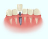 Имплантация зубов «под ключ» с пожизненной гарантией