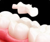 Керамическая вкладка на зубы