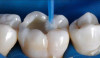 Восстановление стершихся зубов
