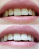 Отбеливание эмали зубов для девушек в Караганде
